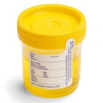 Urinokultura, Analiza urina, sediment urina